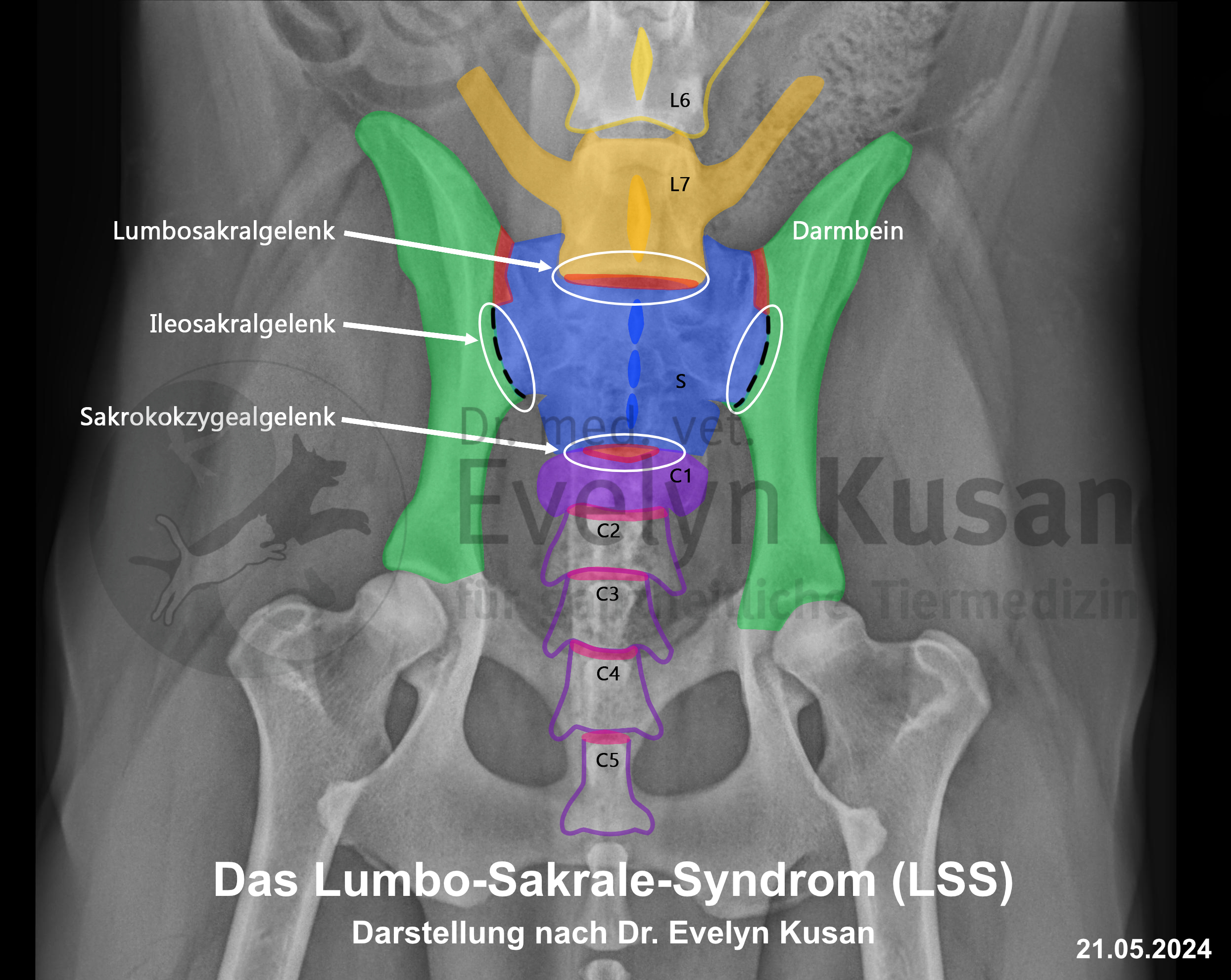 Lumbo Sakrales Syndrom Röntgenaufnahme mit Markierungen